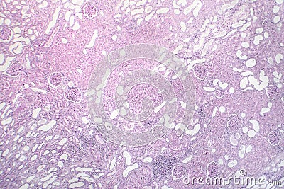 Cloudy swelling of the renal tubules in kidney Stock Photo