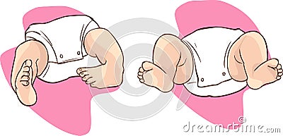 Club foot closeup of a newborn Vector Illustration