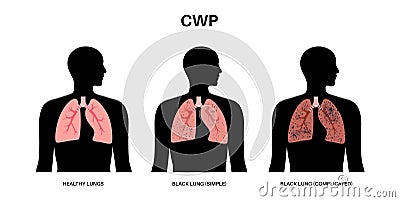 Coal workers disease Vector Illustration