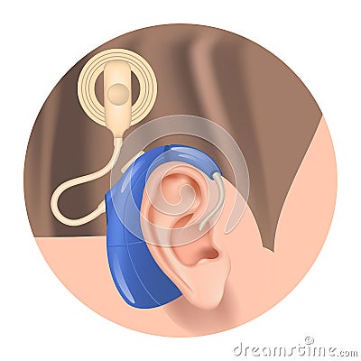 Cochlear implant. Hearing aid in the ear. Vector Illustration