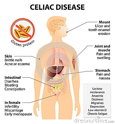 Coeliac disease or celiac disease Vector Illustration