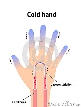 Cold hand blood circulation illustration sensitivity to cold, cold fingertips Vector Illustration