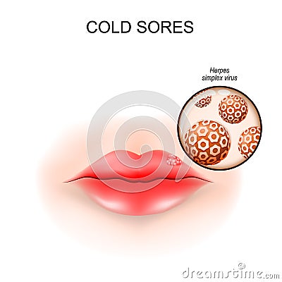 Cold sores in the lip. fever blisters Vector Illustration