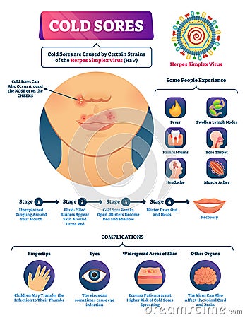 Cold sores vector illustration. Medical labeled herpes simplex virus scheme Vector Illustration