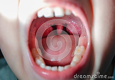 Colds open mouth with red, inflamed glands Stock Photo