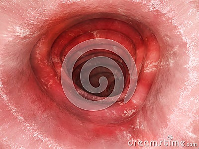 Colitis ulcerosa - Stage 2 - 3D rendering Stock Photo