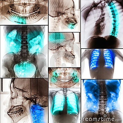 Collage of human X-rays photo Stock Photo