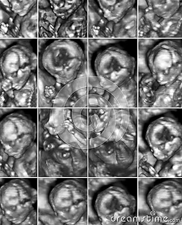 Collage of 16 medical images of 3D ultrasound anomaly scan on a Stock Photo