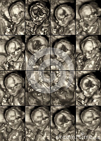 Collage of 16 medical images of 3D ultrasound anomaly scan on a Stock Photo