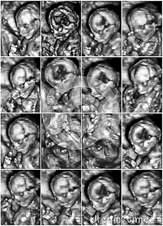 Collage of 16 medical images of 3D ultrasound anomaly scan on a Stock Photo