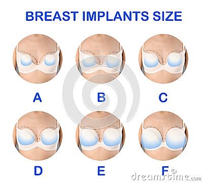 Collage with photos of woman demonstrating implant sizes for breast on white background, closeup Stock Photo