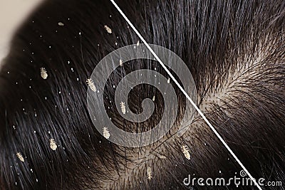 Collage showing woman`s hair before and after lice treatment, closeup. Suffering from pediculosis Stock Photo