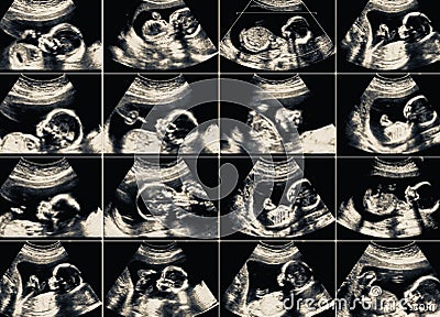 Collage of 16 ultrasonography fetus pictures Stock Photo