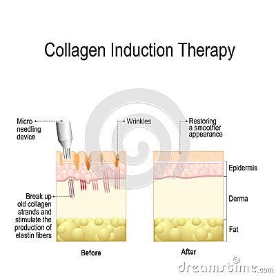 Collagen induction therapy microneedling Vector Illustration