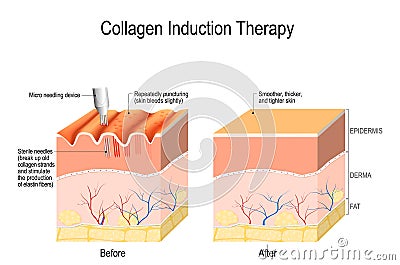 Collagen induction therapy. microneedling the skin Vector Illustration