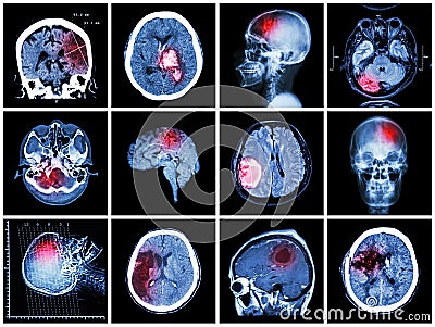 Collection of brain disease Stock Photo