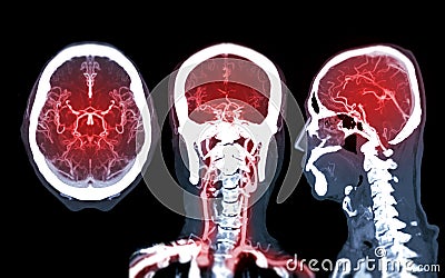 Collection of CTA brain or CT angiography of the brain comparison Mip technique Axial ,Coronal and Sagittal view for detect brain Stock Photo