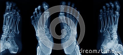 Collection foot x-ray Stock Photo