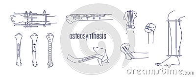 Collection of fractured bones and limbs fixed with metal implantable devices drawn with contour lines on white Vector Illustration