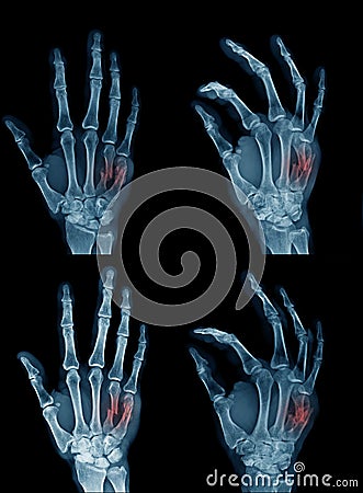 Collection hand x-ray image Stock Photo