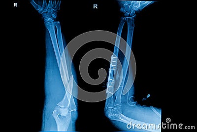 Collection of human x-rays showing fracture of radius bone Stock Photo