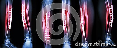 Collection image of leg fracture and surgical treatment by internal fixation with plate and . Break tibia and fibula bone Stock Photo