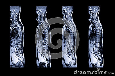 MRI of whole spine T2W sagittal plane . Stock Photo