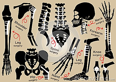 Collection of Orthopedic surgery ( Internal fixation by plate and )( skull , head , neck , spine , sacrum , arm , forearm , Vector Illustration