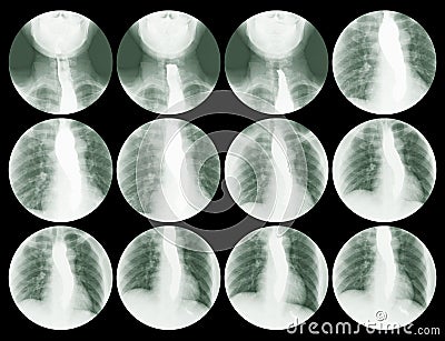 Collection step swallowing test EsophagogramBarium Sulfate BaSO4 ,Medical image concept Stock Photo