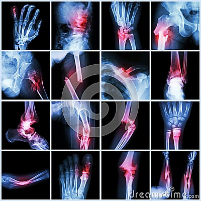 Collection X-ray multiple bone fracture Stock Photo