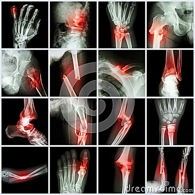 Collection X-ray multiple bone fracture Stock Photo