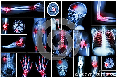 Collection x-ray multiple disease (arthritis,stroke,brain tumor,gout,rheumatoid,kidney stonepulmonary Stock Photo