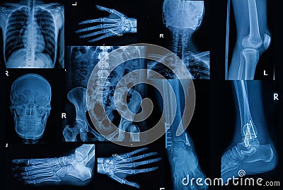 Collection of X-ray , Multiple part of adult show fracture bon Stock Photo