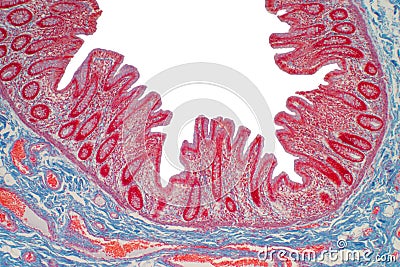 Colon biopsy from the colonoscopy Stock Photo