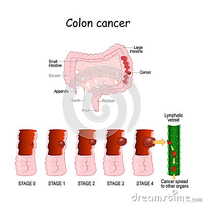 Colon cancer. Colorectal oncology. Stages of Development a malignant tumor Vector Illustration