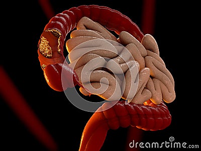 Colon cancer concept as a medical illustration of a large intestine Cartoon Illustration