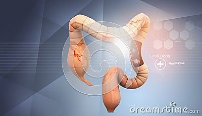 Colon cancer concept Stock Photo