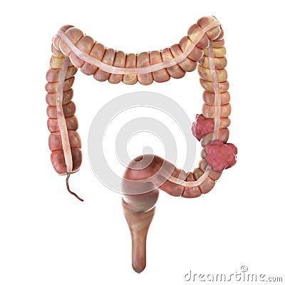 Colon cancer Cartoon Illustration