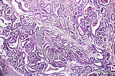 Colon cancer, light micrograph Stock Photo