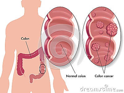 Colon cancer Vector Illustration