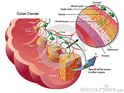 Colon cancer Vector Illustration