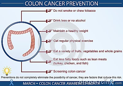 Colon Cancer Prevention Infographic Vector Illustration Vector Illustration