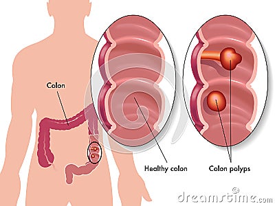 Colon polyps Vector Illustration