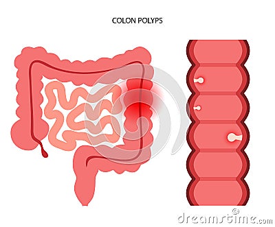 Colon polyps inflammation Vector Illustration