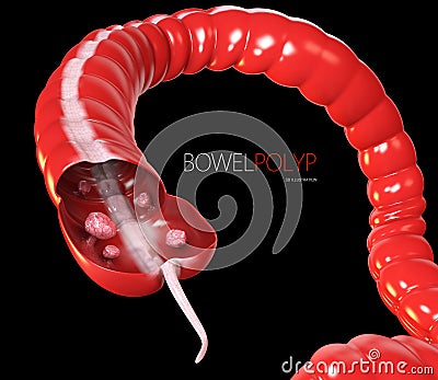 Colon polyps. 3d illustration- Polyp in the intestine. black Cartoon Illustration