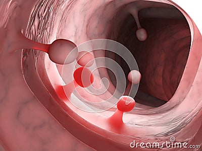 Colon polyps Cartoon Illustration