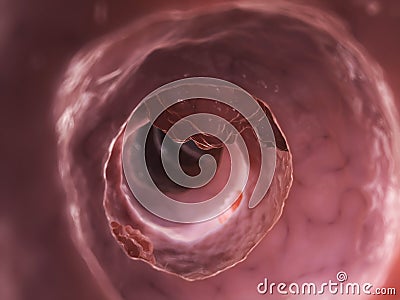 Colon tumor Cartoon Illustration