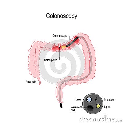 Colonoscope in the colon. detail of the colonoscope Vector Illustration