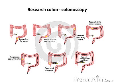 Colonoscopy. Diagnosis of the colon. Infographics. Vector illustration on background Vector Illustration