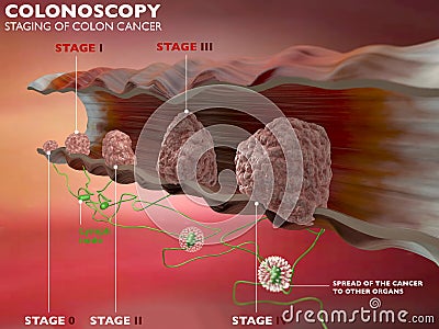 Colonoscopy examination colon digestive system Stock Photo